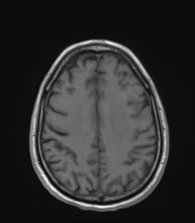 Anaplastic astrocytoma IDH wild-type (Radiopaedia 49984-55273 Axial T1 41).png