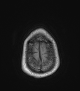 Anaplastic astrocytoma IDH wild-type (Radiopaedia 49984-55273 Axial T1 53).png