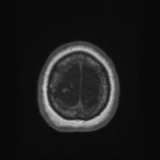 File:Anaplastic astrocytoma IDH wild-type (pseudoprogression) (Radiopaedia 42209-45276 Axial T1 139).png