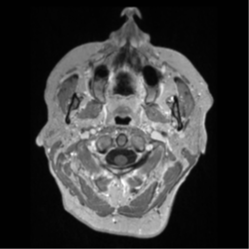 File:Anaplastic astrocytoma IDH wild-type (pseudoprogression) (Radiopaedia 42209-45276 Axial T1 C+ 6).png