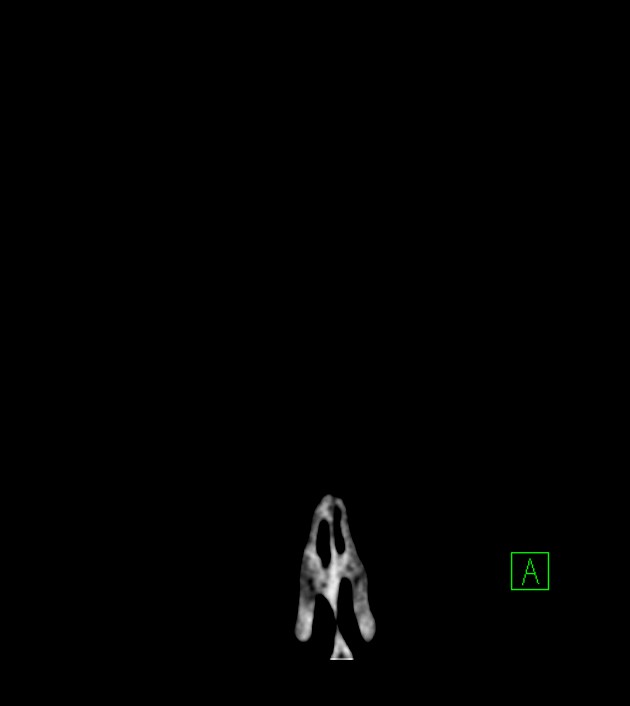 Anaplastic oligodendroglioma (Radiopaedia 79571-92753 Coronal non-contrast 5).jpg