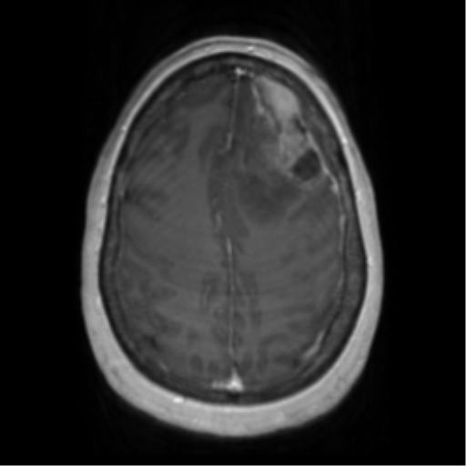 Anaplastic oligodendroglioma (Radiopaedia 83500-98599 Axial T1 C+ 57).png