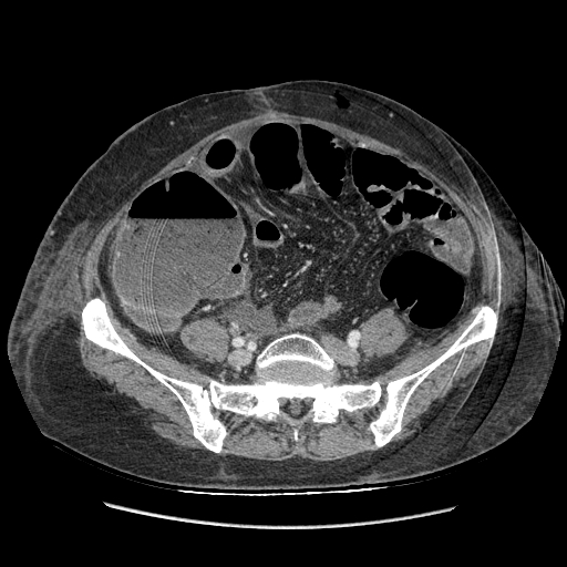 Anastomosis leak at ileostomy closure site (Radiopaedia 82138-96184 B 158).jpg