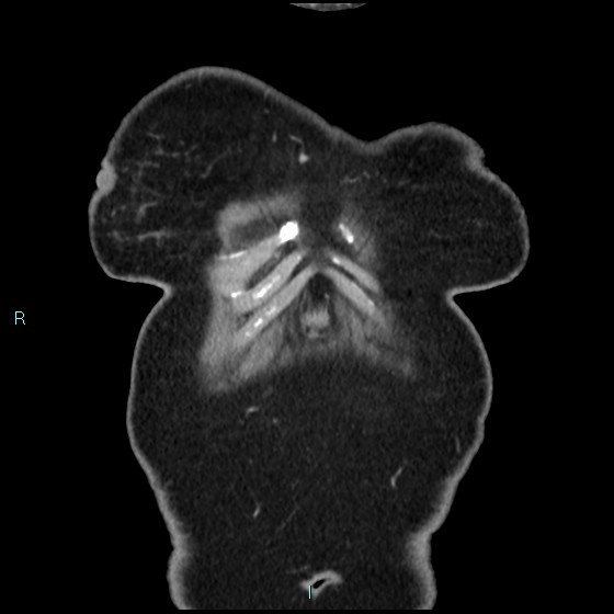Aneurysm of the inferior vena cava (Radiopaedia 65330-74361 C 1).jpg