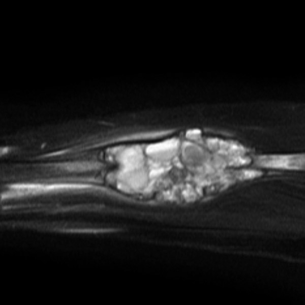 File:Aneurysmal bone cyst - radius (Radiopaedia 5866-7442 Sagittal T2 1).jpg