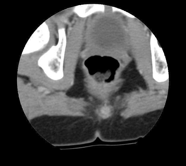 File:Aneurysmal bone cyst - sacrum (Radiopaedia 65190-74195 Axial non-contrast 50).jpg