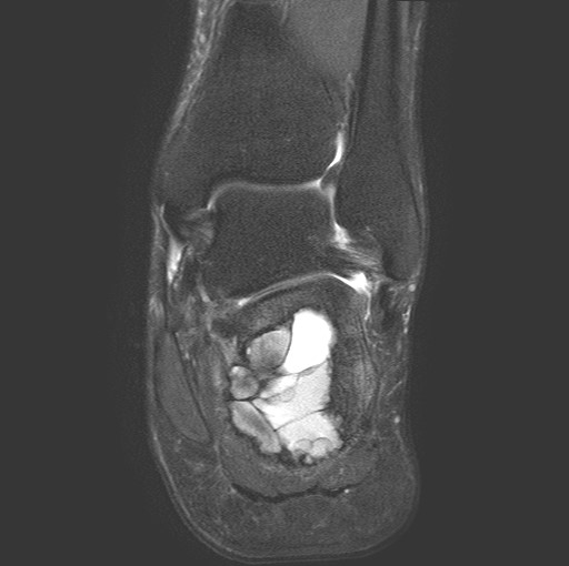 File:Aneurysmal bone cyst of the calcaneus (Radiopaedia 60669-68420 Coronal T2 fat sat 13).jpg
