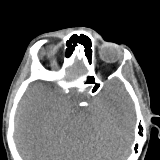 Angular dermoid cyst (Radiopaedia 88967-105790 Axial non-contrast 32).jpg