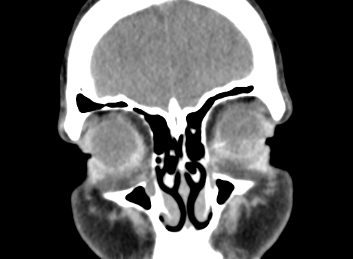 Angular dermoid cyst (Radiopaedia 88967-105790 Coronal non-contrast 17).jpg