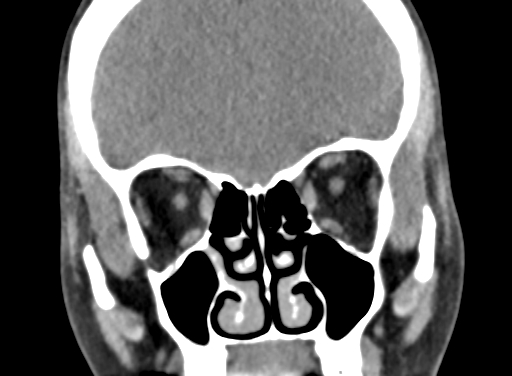 Angular dermoid cyst (Radiopaedia 88967-105790 Coronal non-contrast 31).jpg