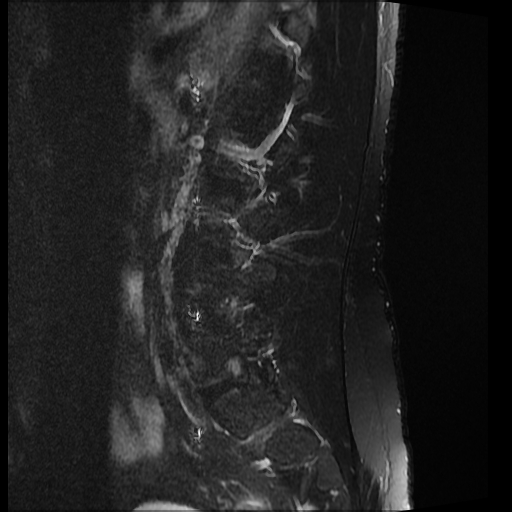 File:Ankylosing spondylitis - shiny corner sign (Radiopaedia 52084-57941 Sagittal T2 fat sat 12).jpg