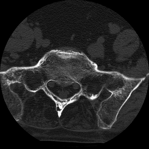 Ankylosing spondylitis complicated by fracture-dislocation (Radiopaedia 33583-34674 Axial non-contrast 152).jpg