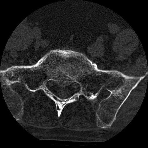File:Ankylosing spondylitis complicated by fracture-dislocation (Radiopaedia 33583-34674 Axial non-contrast 153).jpg