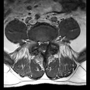 File:Ankylosing spondylitis with zygapophyseal arthritis (Radiopaedia 38433-40516 Axial T1 5).jpg