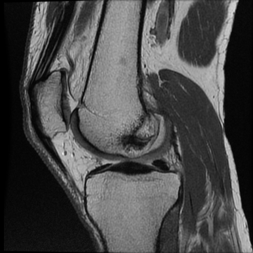 File:Anomalous insertion of the medial meniscus (Radiopaedia 77559-89721 Sagittal PD 32).jpg