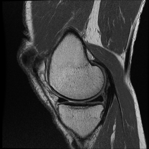 Anomalous insertion of the medial meniscus (Radiopaedia 77559-89721 Sagittal PD 39).jpg
