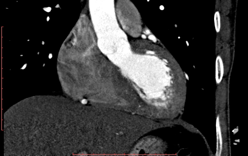 Anomalous left coronary artery from the pulmonary artery (ALCAPA) (Radiopaedia 70148-80181 B 123).jpg