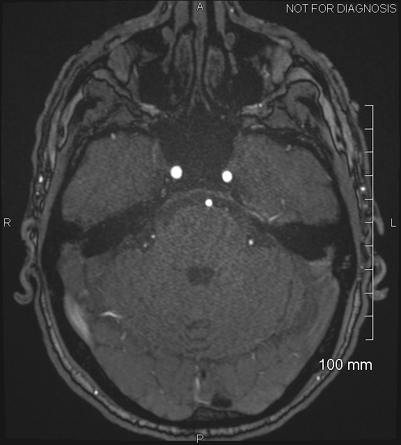 Anterior cerebral artery aneurysm (Radiopaedia 80683-94127 Axial MRA 66).jpg