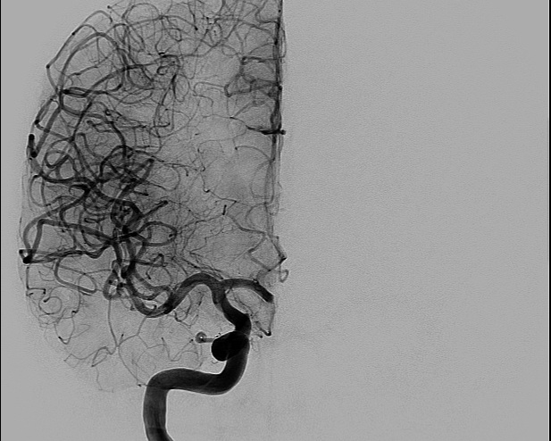 File:Anterior cerebral artery aneurysm (Radiopaedia 80683-94128 A 4).jpg