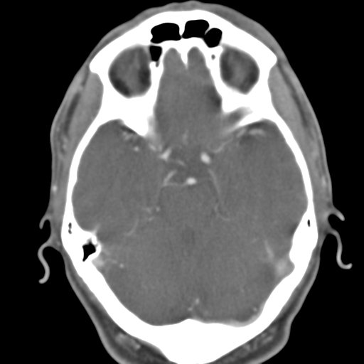 Anterior cerebral artery territory infarct (Radiopaedia 39327-41581 B 38).png