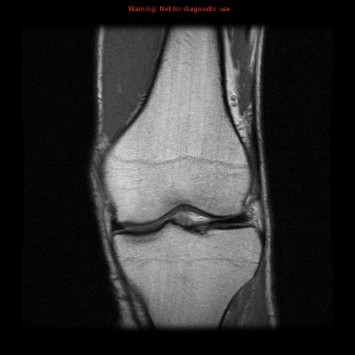 File:Anterior cruciate ligament injury - partial thickness tear (Radiopaedia 12176-12515 Coronal PD 8).jpg