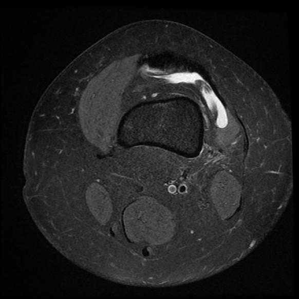 File:Anterior cruciate ligament tear, Wrisberg rip and bucket-handle tear of medial meniscus (Radiopaedia 75872-87266 Axial PD fat sat 26).jpg