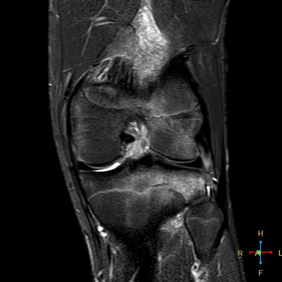 File:Anterior cruciate ligament tear - complete (Radiopaedia 24907-25170 Coronal STIR 13).jpg