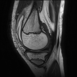 Anterior cruciate ligament tear - pediatric (Radiopaedia 62152-70260 Sagittal PD 51).jpg