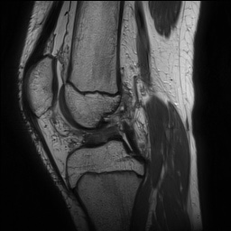 Anterior cruciate ligament tear - pediatric (Radiopaedia 62152-70260 Sagittal PD 86).jpg