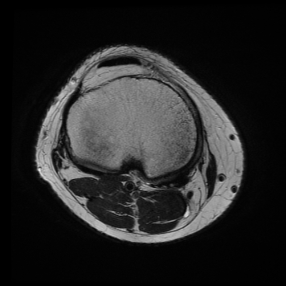 File:Anterior cruciate ligament tear with posteromedial corner injury, bucket-handle meniscal tear and chondral delamination (Radiopaedia 75501-86744 Axial T2 6).jpg
