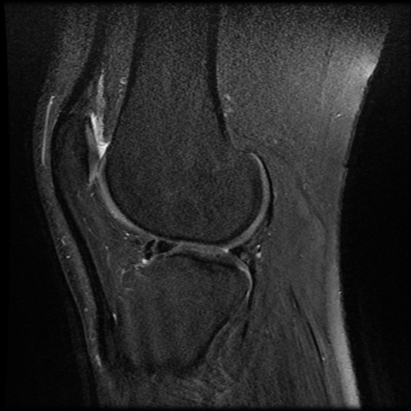File:Anterior cruciate ligament tear with posteromedial corner injury, bucket-handle meniscal tear and chondral delamination (Radiopaedia 75501-86744 Sagittal PD fat sat 19).jpg
