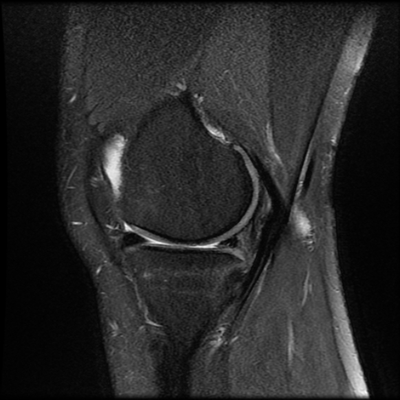 File:Anterior cruciate ligament tear with posteromedial corner injury, bucket-handle meniscal tear and chondral delamination (Radiopaedia 75501-86744 Sagittal PD fat sat 7).jpg