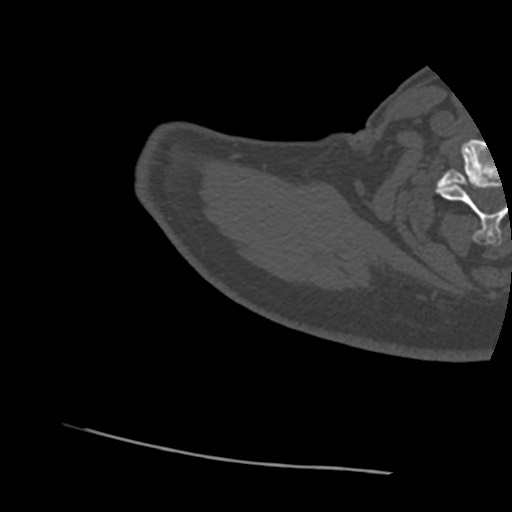Anterior glenohumeral dislocation with Hill-Sachs lesion (Radiopaedia 62877-71249 Axial bone window 3).jpg