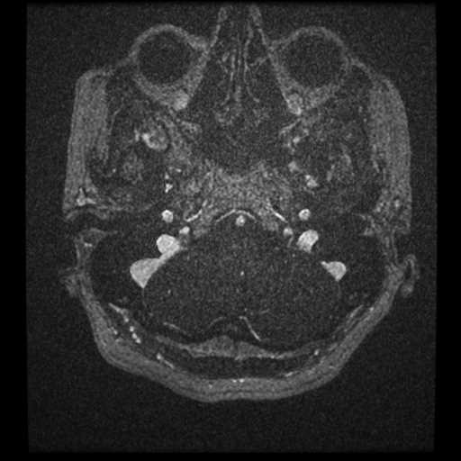Anterior inferior cerebellar artery vascular loop - type II (Radiopaedia 70991-81209 Axial T1 C+ 83).jpg