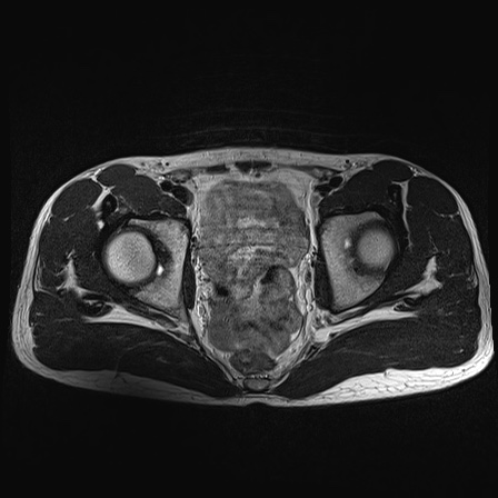File:Anterior inferior iliac spine avulsion fracture (Radiopaedia 81312-95000 Axial T2 19).jpg