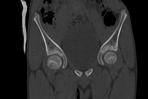Anterior inferior iliac spine avulsion injury (Radiopaedia 88666-105376 Coronal bone window 28).jpg