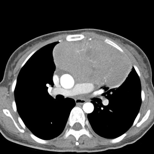 File:Anterior mediastinal lymphoma (Radiopaedia 29556-30061 C 25).jpg