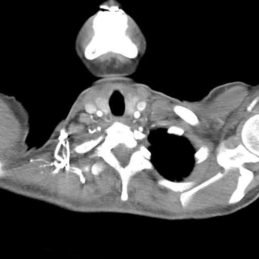 Anterior mediastinal lymphoma (Radiopaedia 29556-30061 C 4).jpg