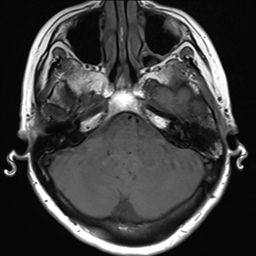 File:Anterior temporal encephalocele (Radiopaedia 82624-96808 Axial T1 7).jpg