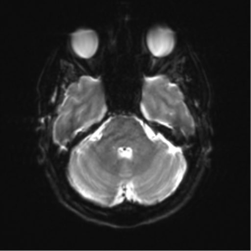 Anterior temporal lobe perivascular space (Radiopaedia 40946-43650 Axial DWI 7).png