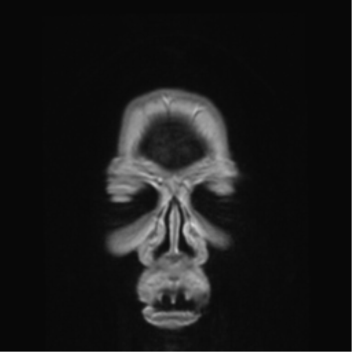 Anterior temporal pole cysts (Radiopaedia 46629-51102 Coronal T1 C+ 174).png