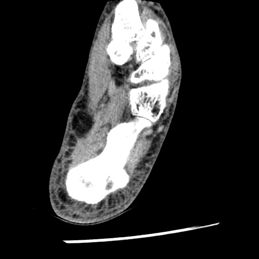Anterior tibial artery false aneurysm (Radiopaedia 88984-105809 A 206).jpg