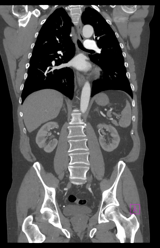 Aortectomy and axillary-bifemoral bypass (Radiopaedia 28303-28545 C 56).jpg