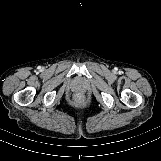 File:Aortic aneurysm and Lemmel syndrome (Radiopaedia 86499-102554 A 84).jpg