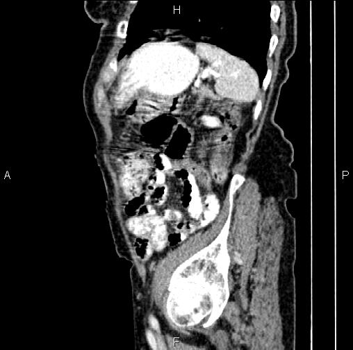 File:Aortic aneurysm and Lemmel syndrome (Radiopaedia 86499-102554 D 73).jpg