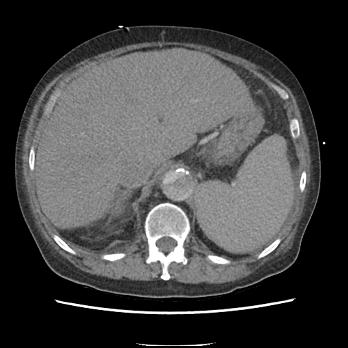 Aortic arch graft infection (FDG PET-CT) (Radiopaedia 71975-82437 A 61).jpg