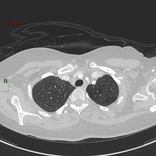 Aortic arch origin of left vertebral artery (Radiopaedia 51520-57286 Axial lung window 46).jpg