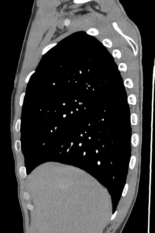 Aortic coarctation with aneurysm (Radiopaedia 74818-85828 B 39).jpg