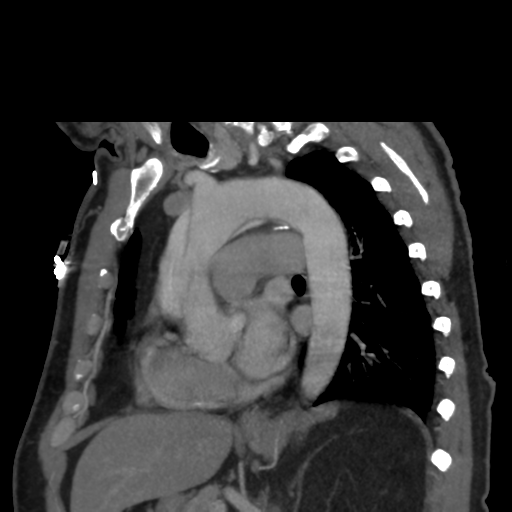 File:Aortic dissection- Stanford A (Radiopaedia 37759-39664 D 18).png