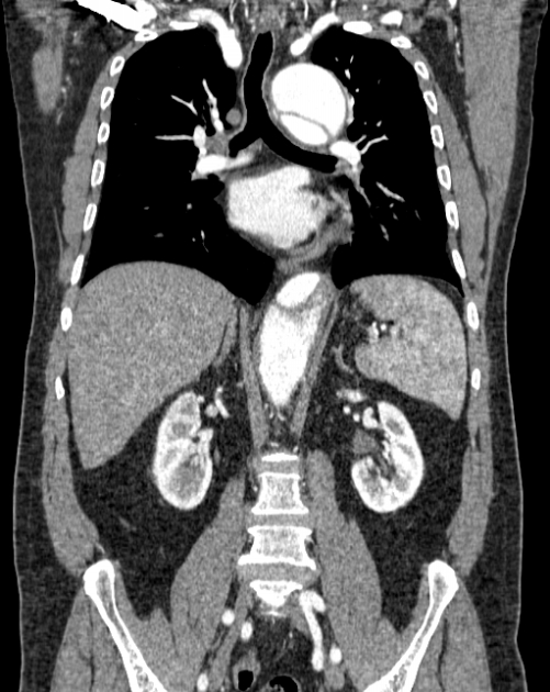Aortic dissection (Radiopaedia 44411-48061 A 32).jpg